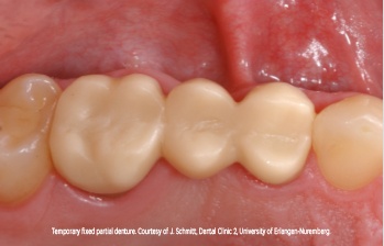 temporary fixed partial denture (002).jpg