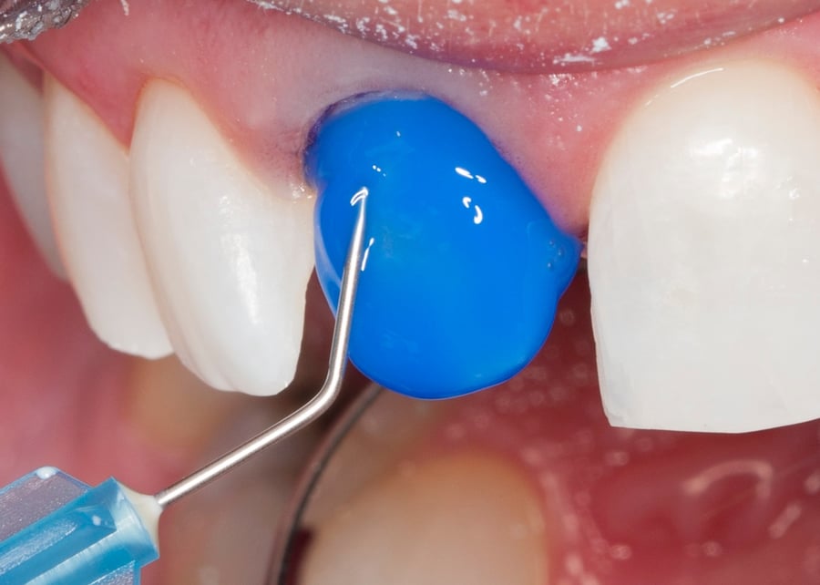 Industry Secrets The Art Of Etching Optident