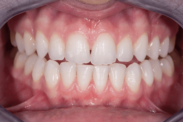 White Dental Beauty Whitening Results