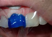 U Veneers - a new breed of dental restoration-4