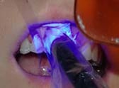 U Veneers - a new breed of dental restoration-6