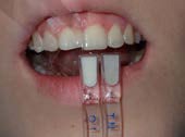 U Veneers - a new breed of dental restoration-7