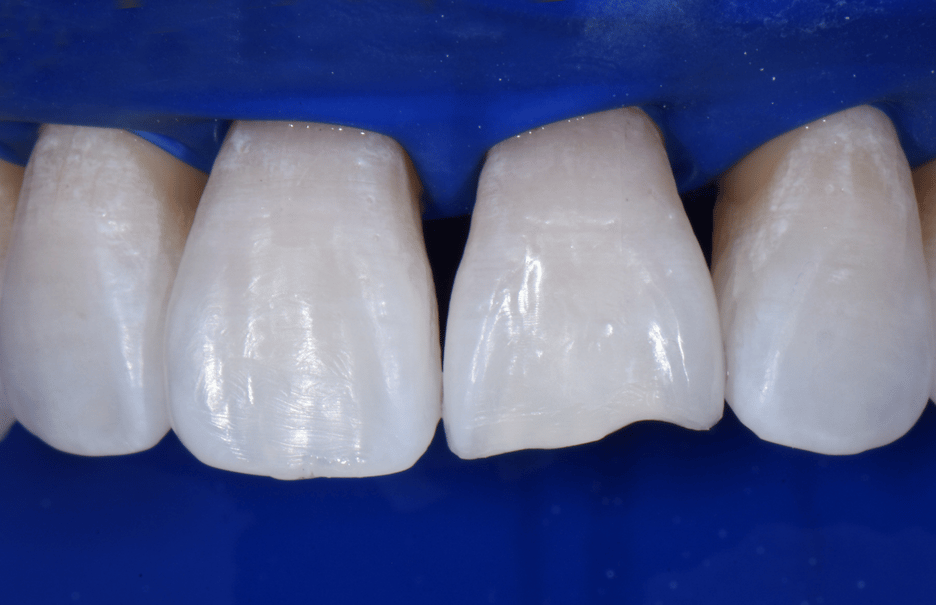 How Bioclear Empowers Dentists To Treat Black Triangles - Optident