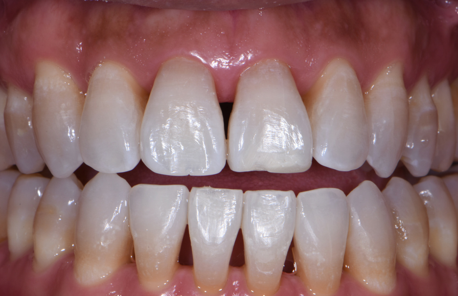 How Bioclear Empowers Dentists To Treat Black Triangles - Optident