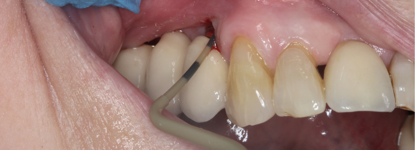 Dental-Implant-Health-Assessment.png