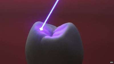 Teeth-laser