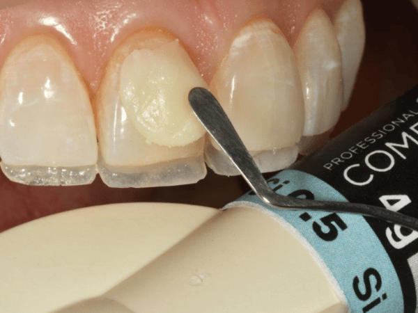 CompoSite can be used in conjunction with enamel for a two-layer technique