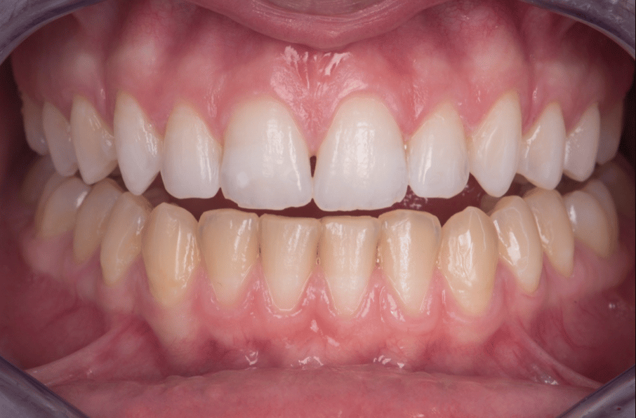Tooth Whitening Before and After