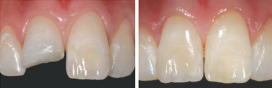 Dental photography (before & after shot)