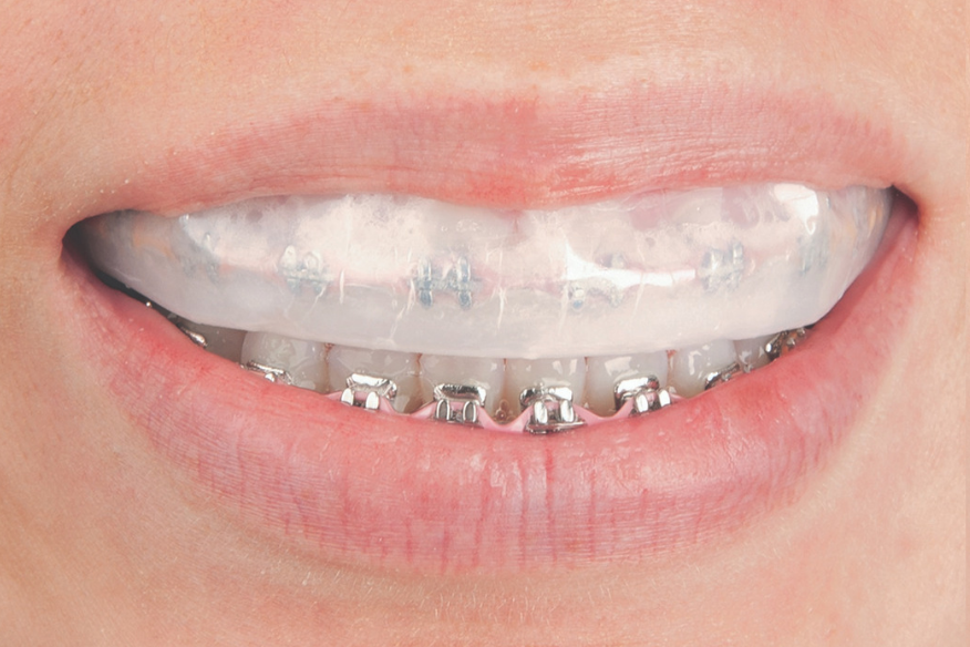 What Patients Need to Know About Whitening with Braces Optident
