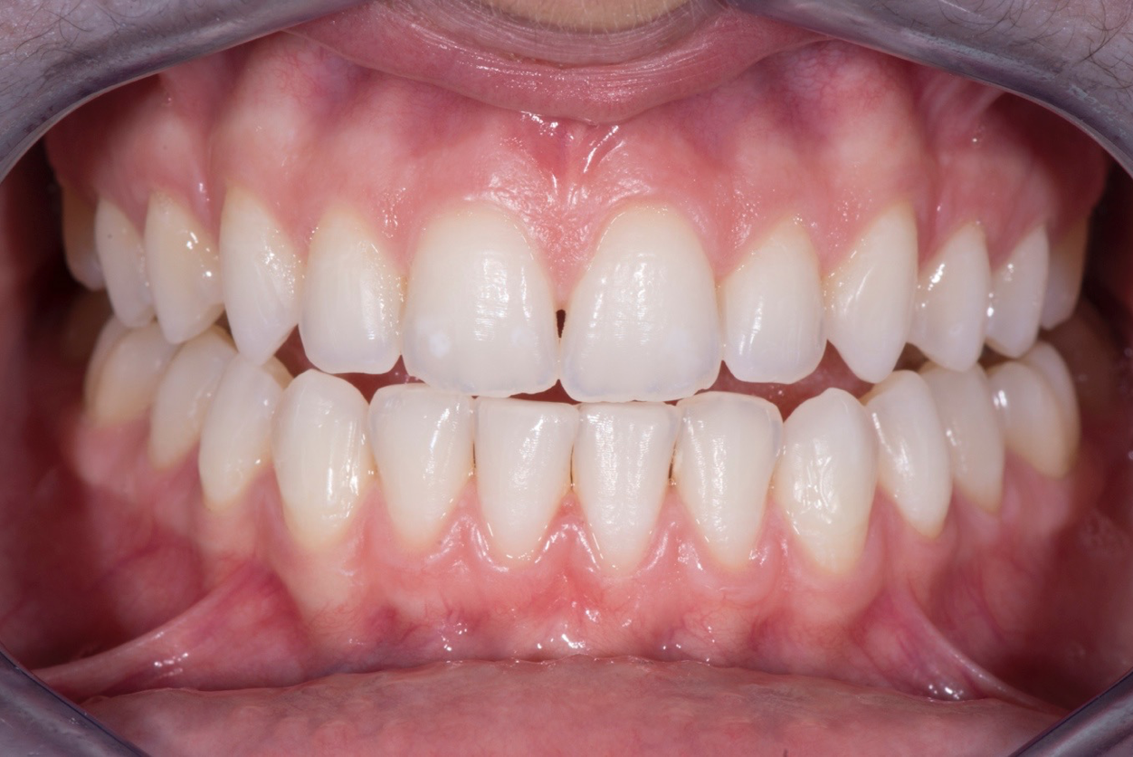 Whitening After