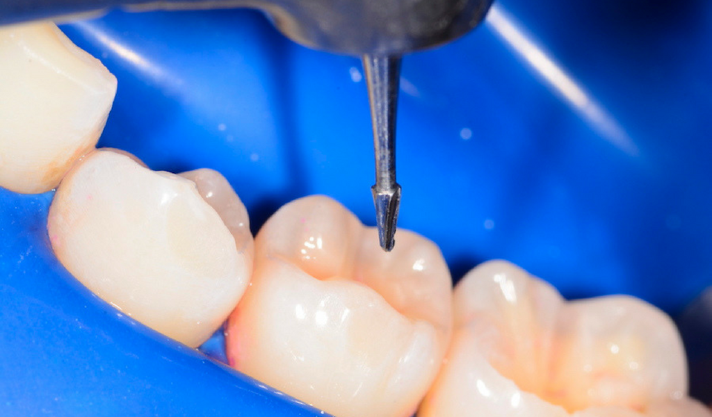 How Bioclear Challenges Age-Old Thinking About the Treatment Of Caries
