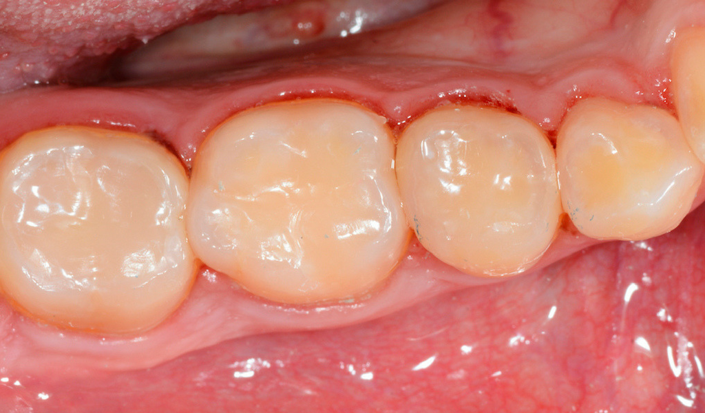 How Bioclear Challenges Age-Old Thinking About the Treatment Of Caries