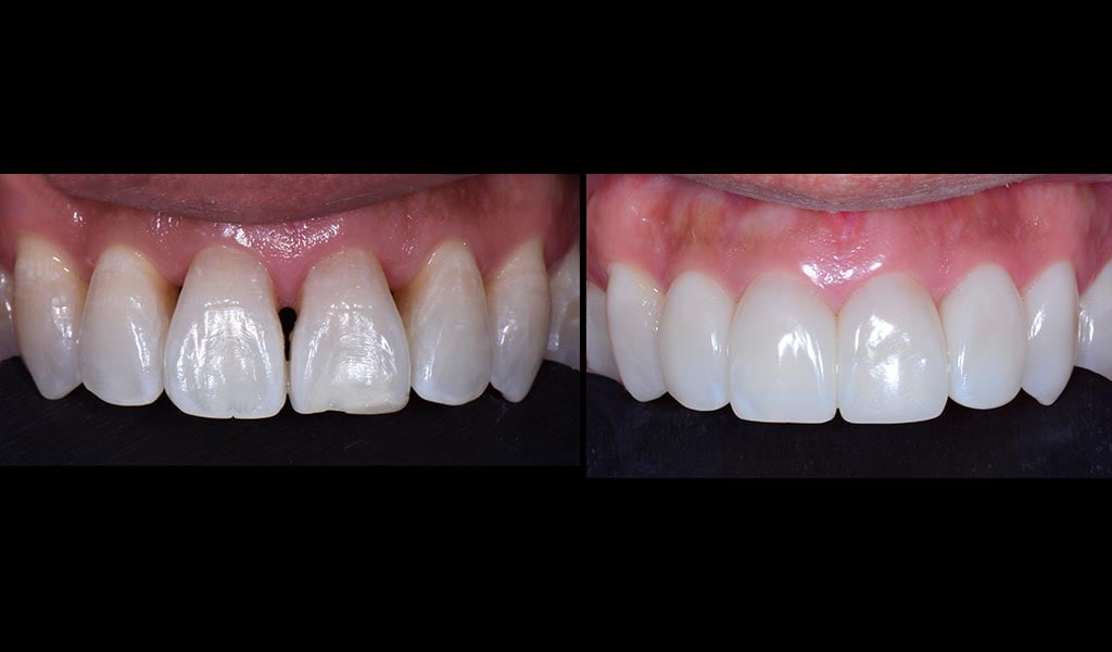 Before & After Bioclear Matrix - Black Triangle Treatment
