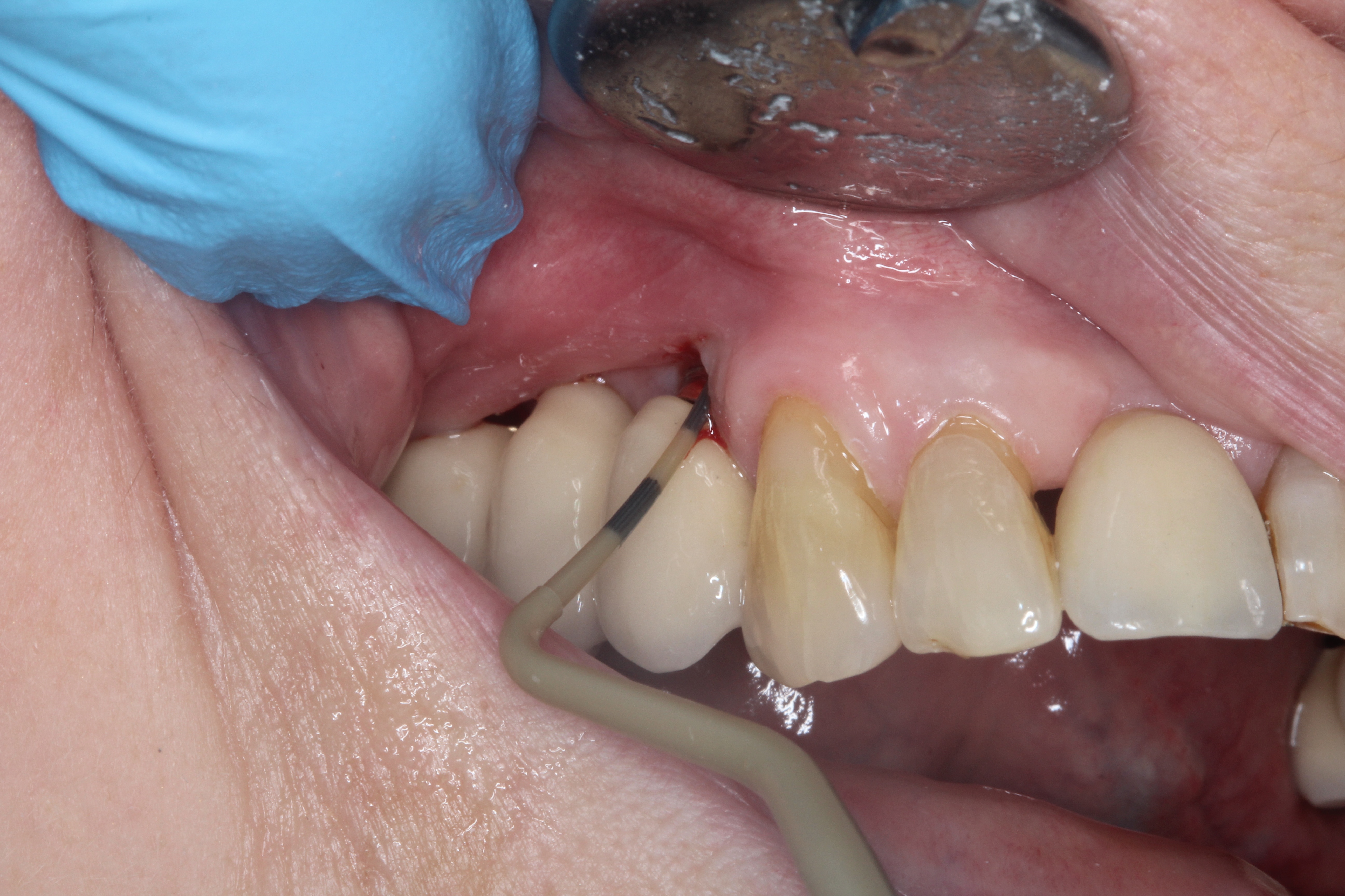 deppeler-pp12-dental-implant-probe.jpg